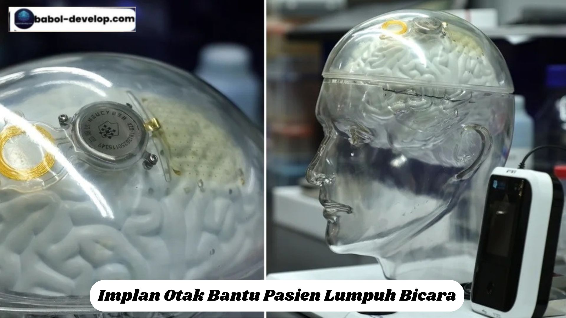 Implan Otak Bantu Pasien Lumpuh Bicara